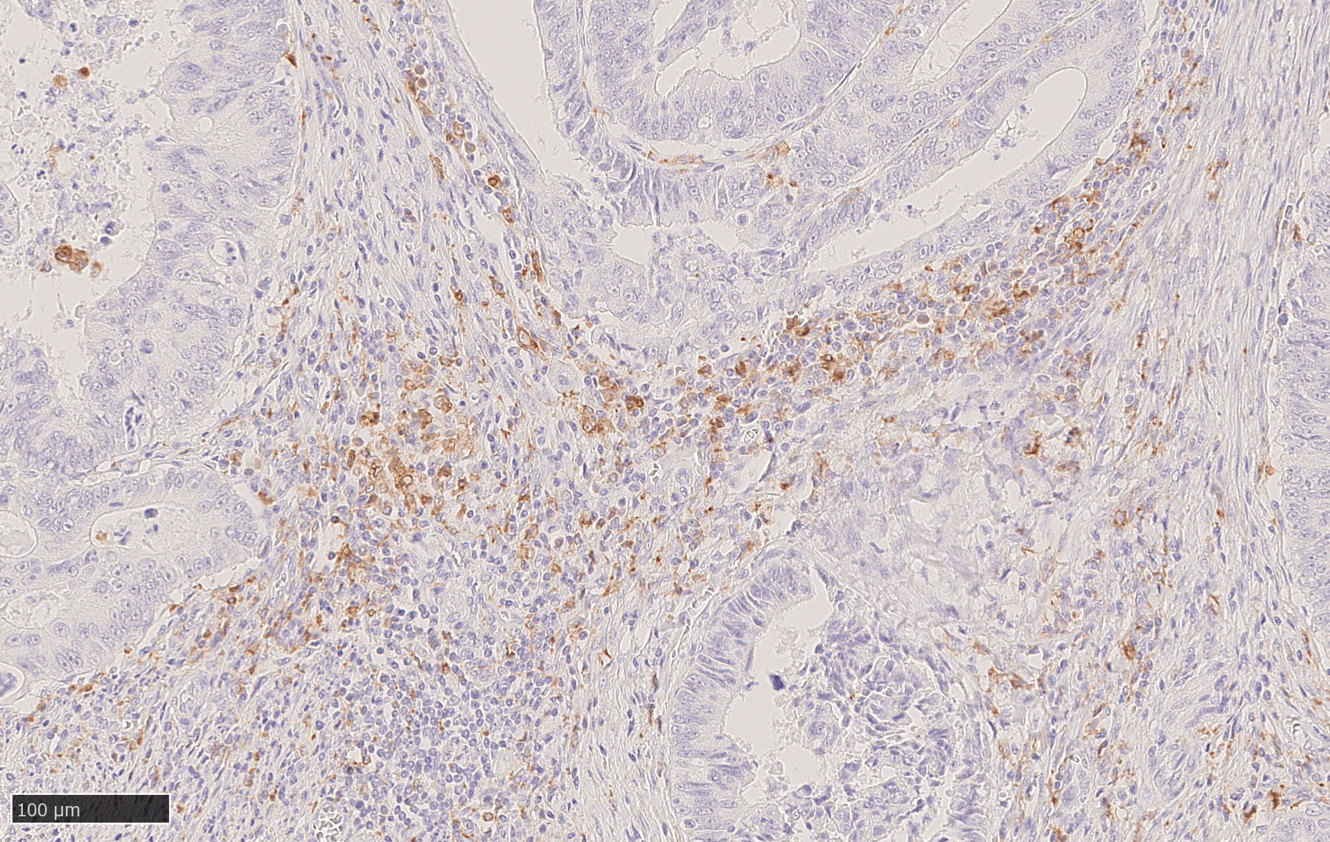 CD68 ｈ結腸癌