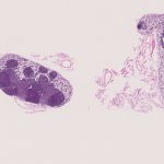 腸間膜リンパ