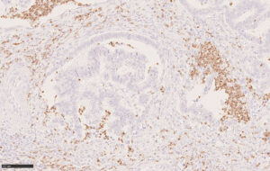 Neutrophil Elastase h結腸癌 x20
